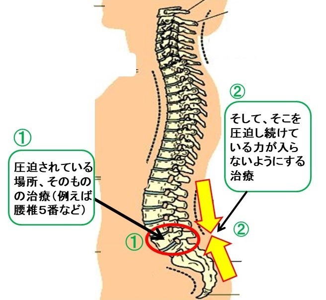 分離すべり症画像2.jpg